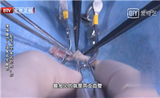 肝脏移植手术中的血管缝合